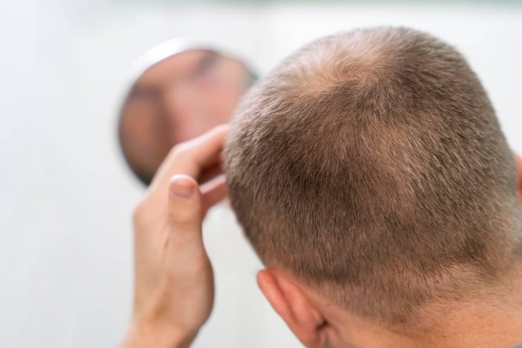 skartisyel alopesi nedir